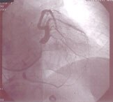 Coronary venogram